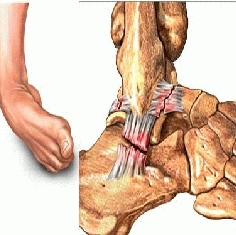 Entorse Centre Orthop dique Pasteur Lanroze